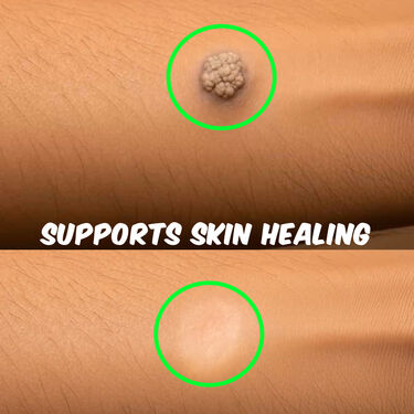 Massa Remover Gel (BCMR)